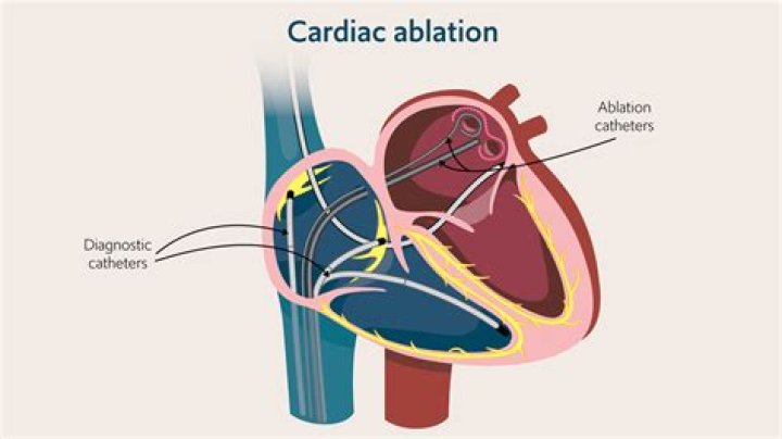 Are you catheterized during cardiac ablation?