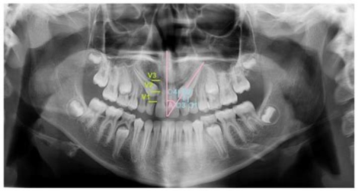 Can 2nd molars be impacted?