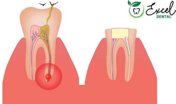 Can a root canal be done if there is an infection?