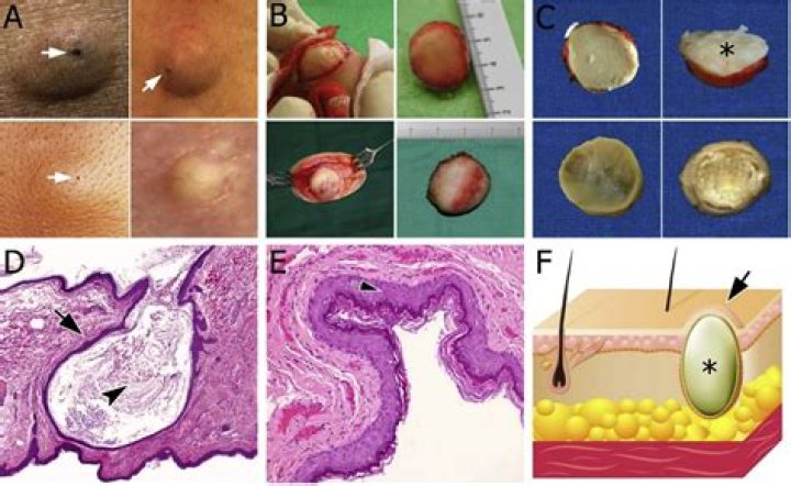 Can an epidermoid cyst be cancerous?