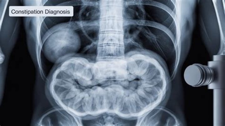 Can an X-ray show impacted stool?