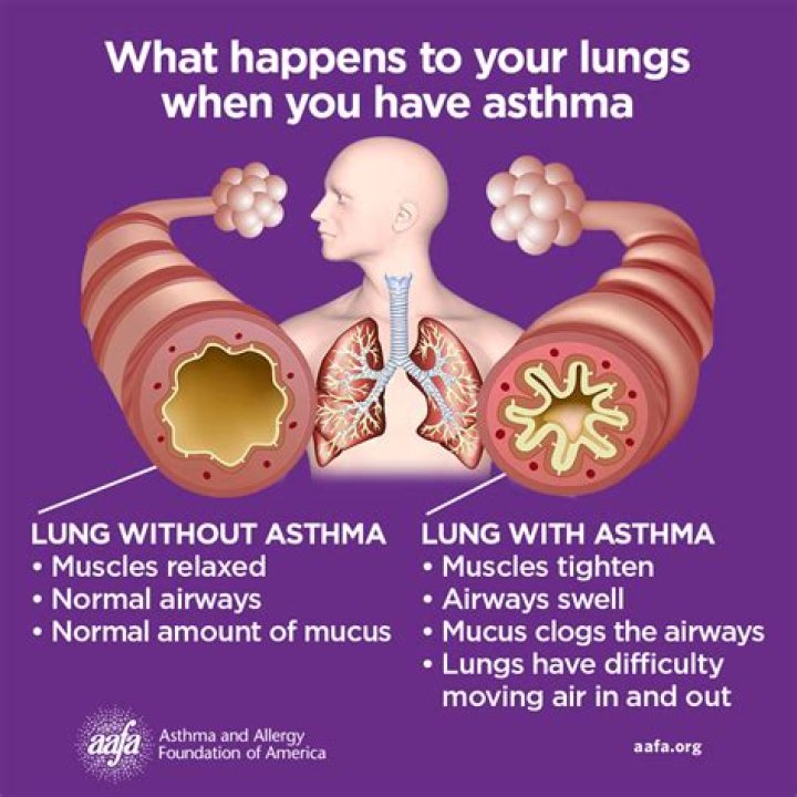 Can being out of shape cause asthma?