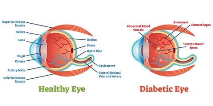 Can diabetes affect your eyes?