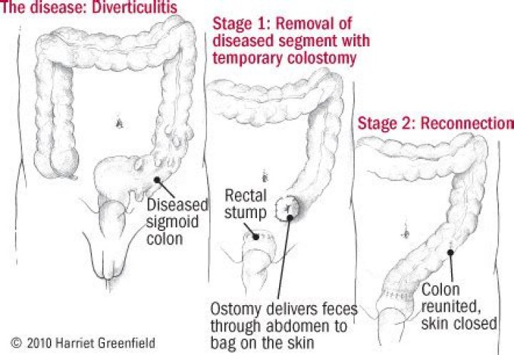 Can diverticula be removed during colonoscopy?
