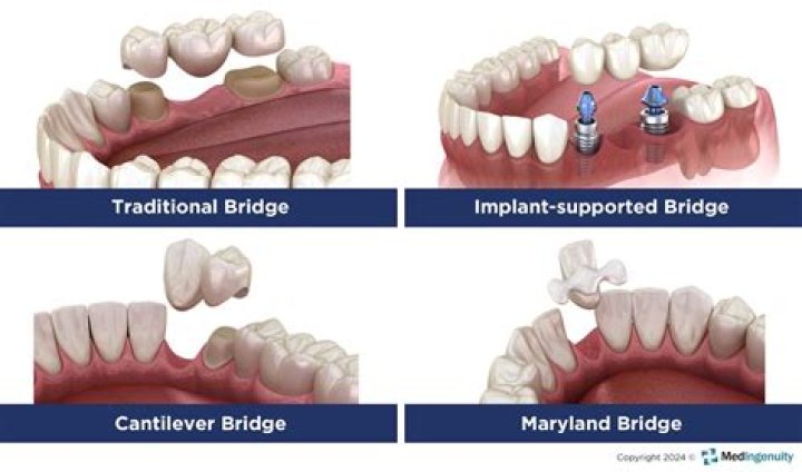 Can everyone have a dental bridge?