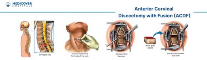 Can I lift weights after ACDF?