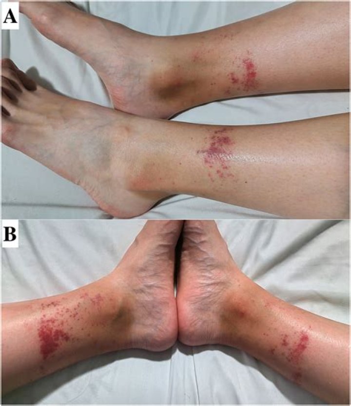 Can levamisole cause vasculitis?