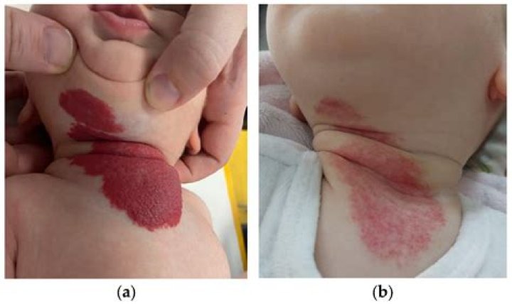 Can low iron cause hemangiomas?