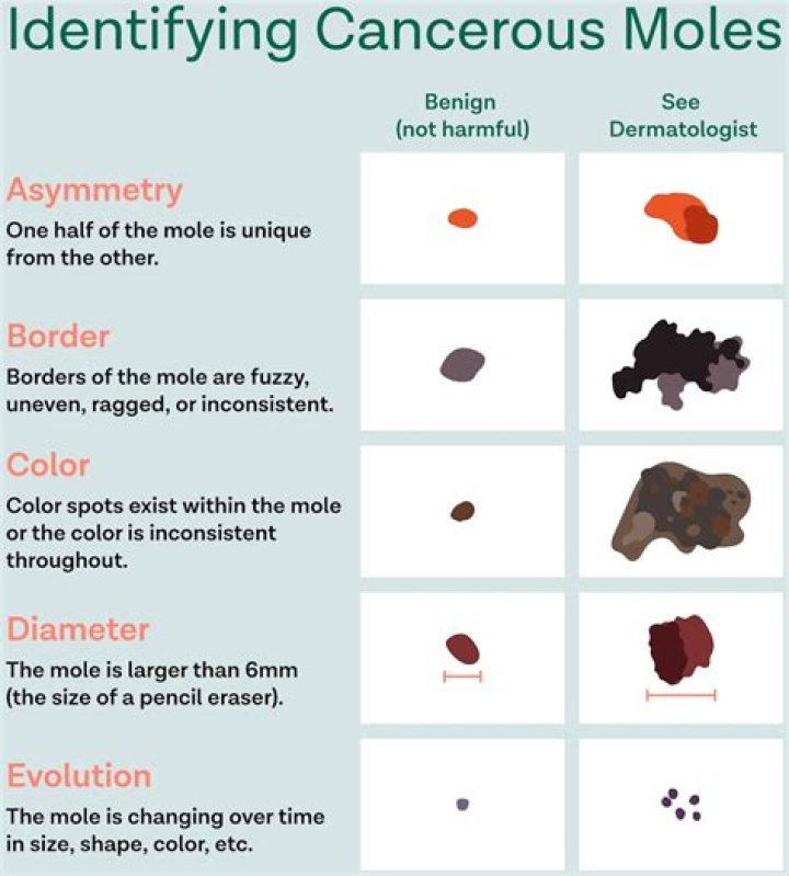 Can moles bleed and not be cancer?