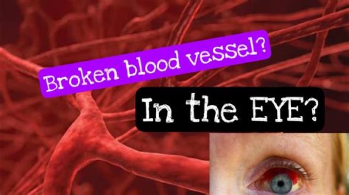 Can pregnancy cause broken blood vessels eye?