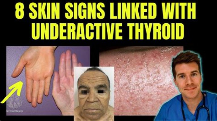 Can thyroid problems cause dry skin?