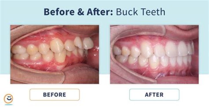 Can you get braces for buck teeth?
