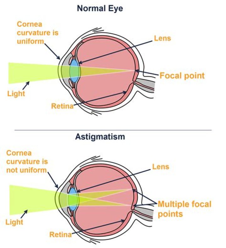 Can you get LASIK with astigmatism and nearsightedness?