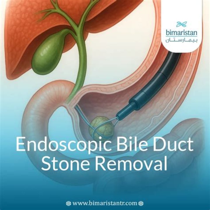 Can you get stones in bile duct after gallbladder removal?