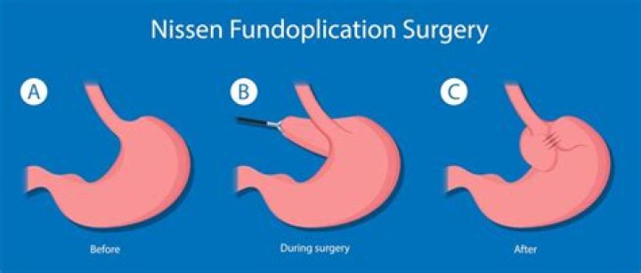 Can you have a baby after Nissen fundoplication?