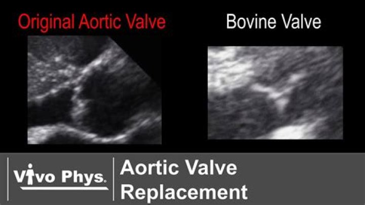 Can you have an MRI with a bovine heart valve?
