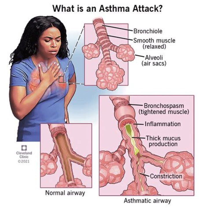 Can you have both asthma and bronchitis?