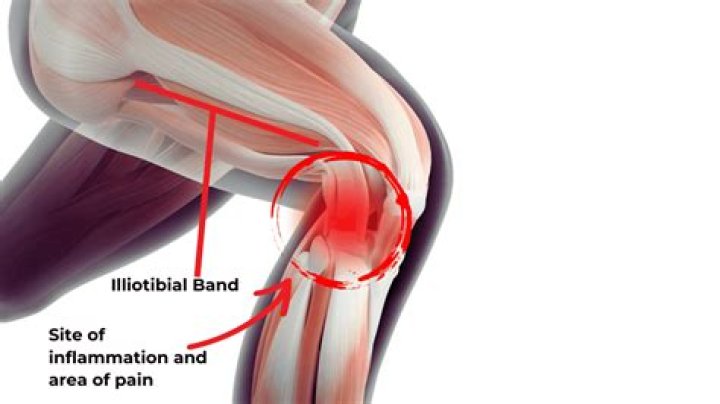 Can you run through ITBS pain?