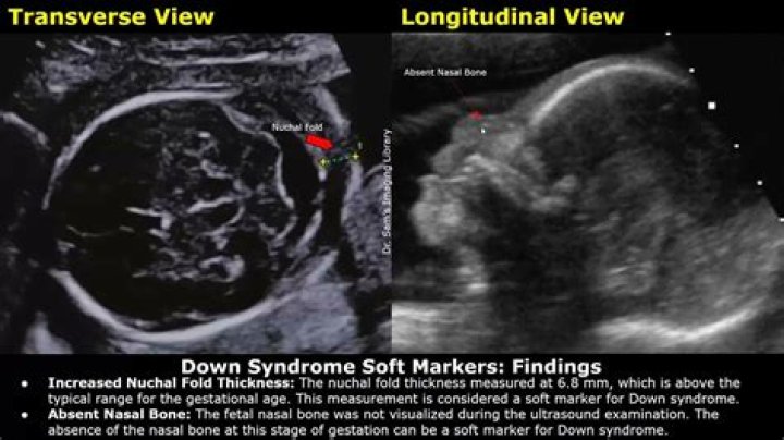 Can you see Down syndrome on ultrasound?