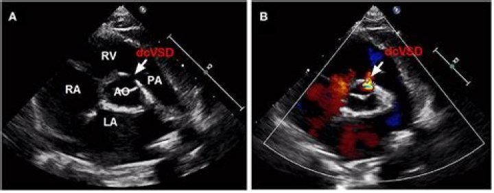 Can you see VSD on Echo?