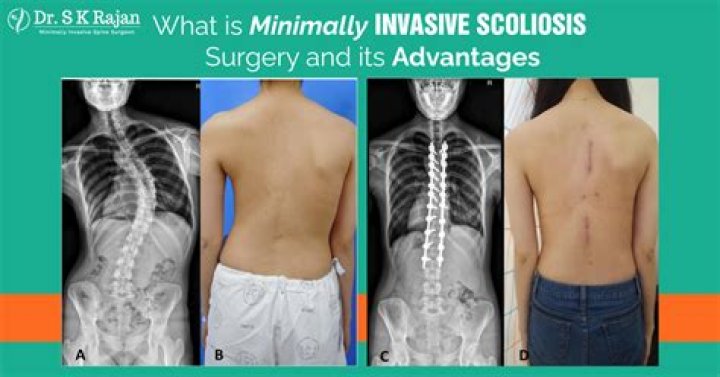 Can you straighten a scoliosis back?