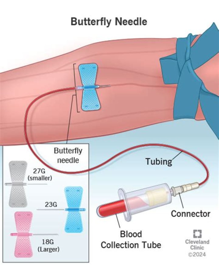 Can you use a butterfly needle to donate blood?
