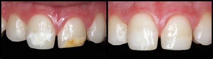 Do cavity fillings need to be replaced?