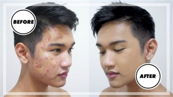 Do guys wear makeup to cover acne?