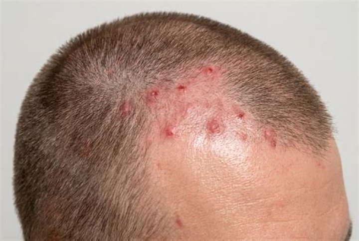 Do scalp scars go away?