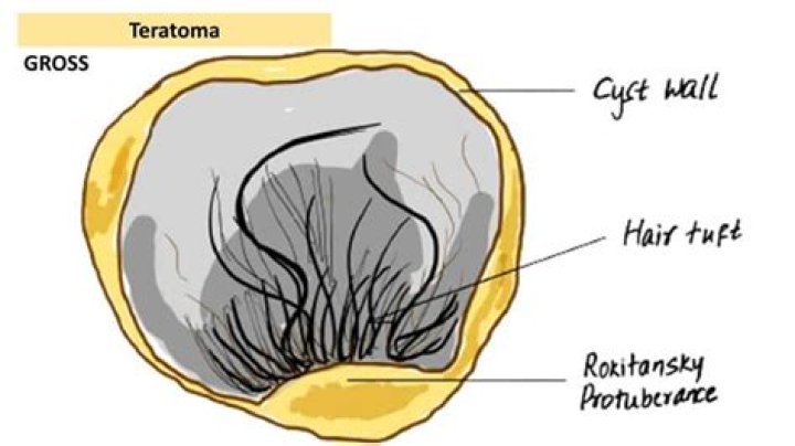 Do teratomas affect fertility?