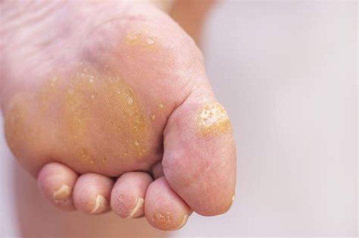 Do warts on the bottom of your feet itch?