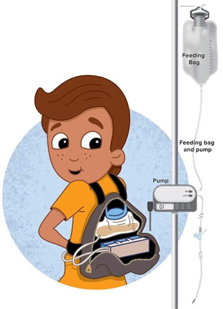 Do you have to stay in the hospital with a feeding tube?