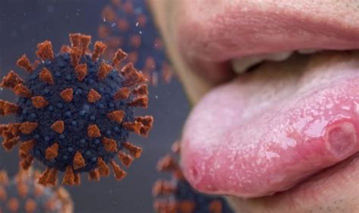 Does Covid cause blisters on tongue?