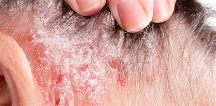 Does eczema cause body hair loss?