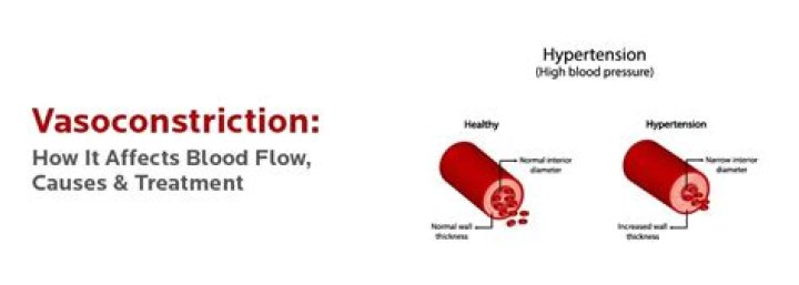 Does hypocapnia cause cerebral vasoconstriction?
