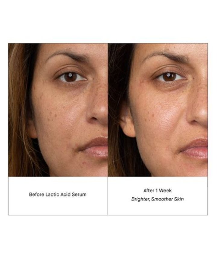 Does lactic acid lighten skin?