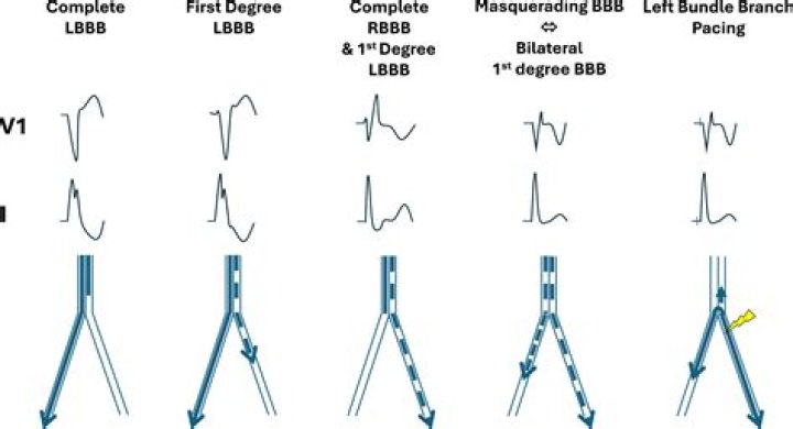 Does Rbbb cause tachycardia?