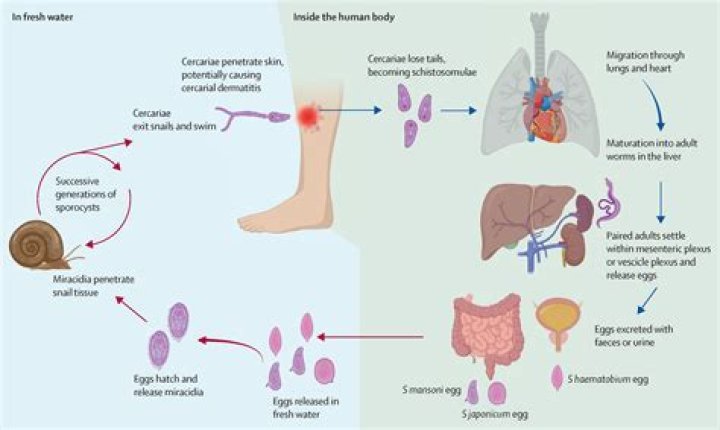Does schistosomiasis cause colitis?