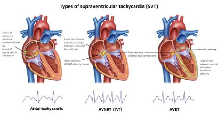 Does Seroquel cause tachycardia?