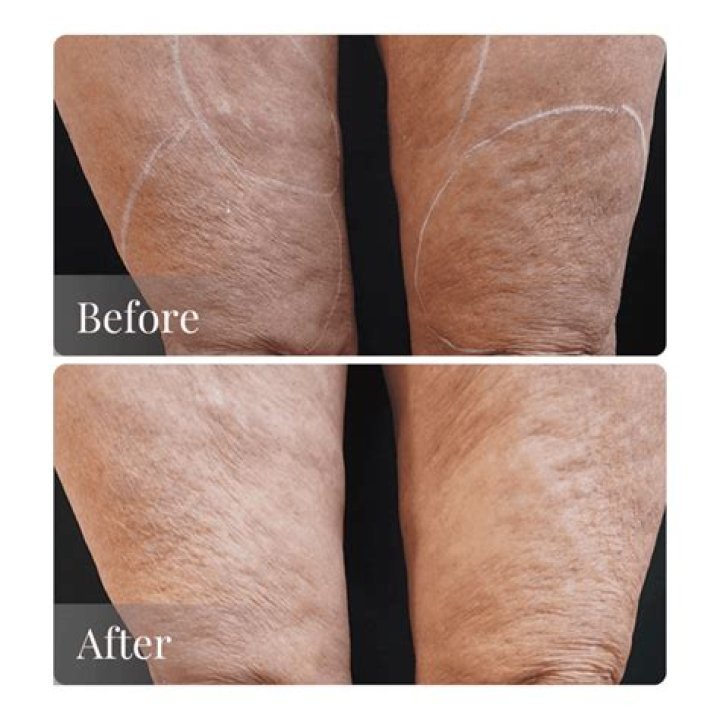 Does TRIA tighten skin?