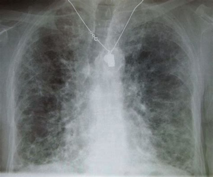 Has anyone survived lung fibrosis?