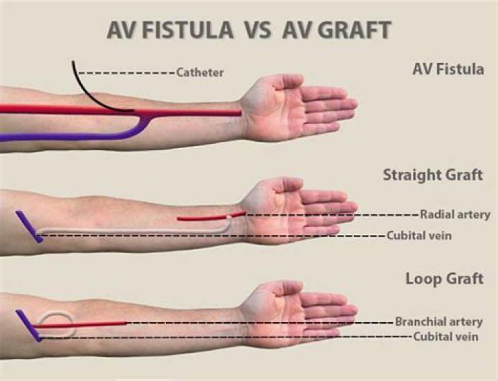 How AV fistula is created?