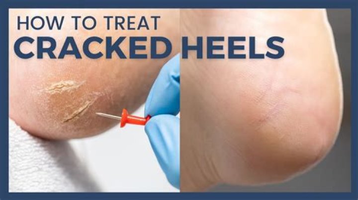 How can I permanently heal my cracked feet?