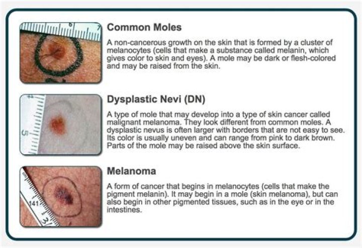 How can you tell the difference between melanoma and nevus?