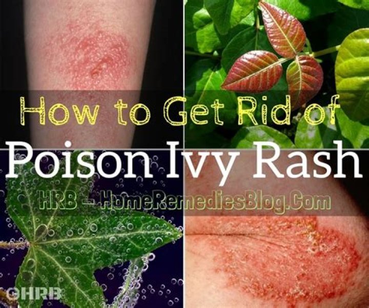 How do I get rid of poison ivy fast?