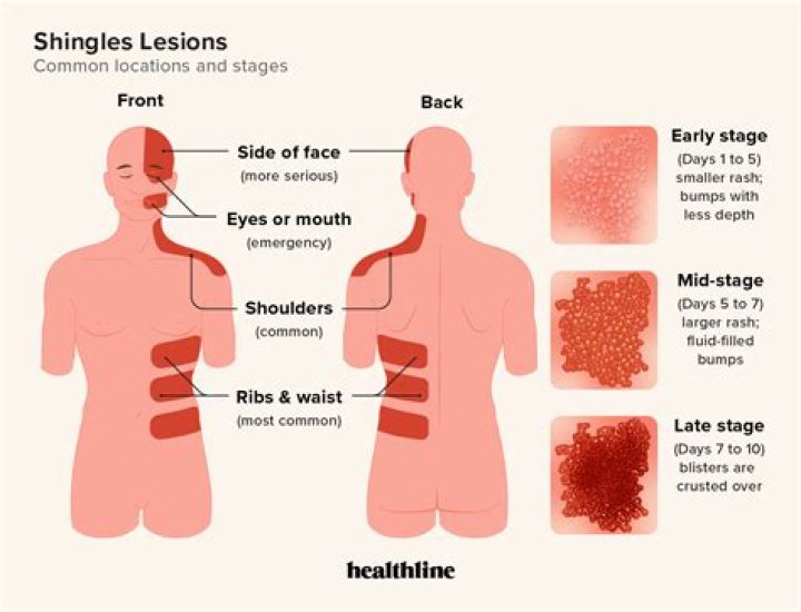 How do I know if I have shingles on my face?