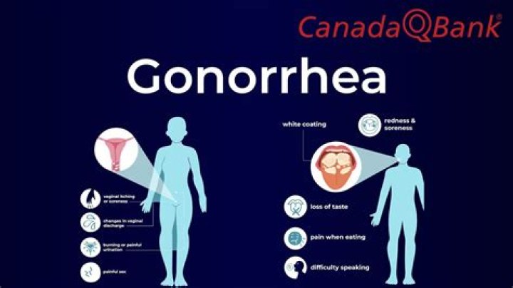 How do u know if u have gonorrhea?