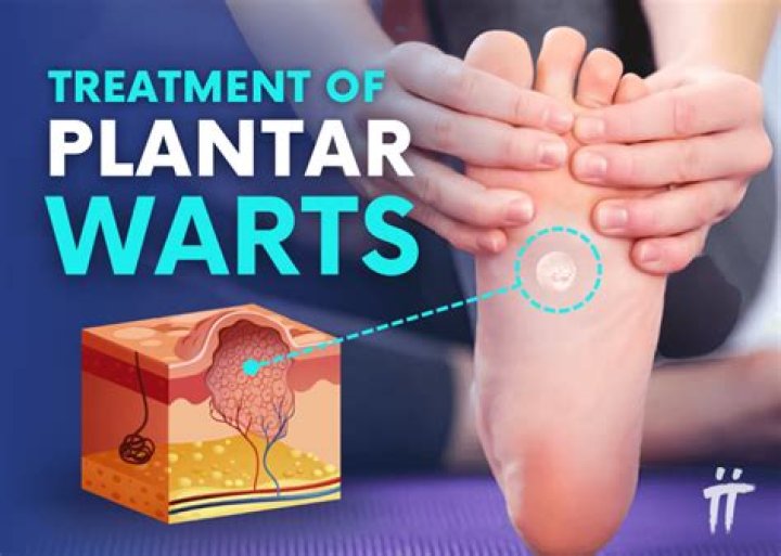 How do you cure a planters wart?