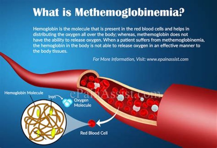 How do you diagnose methemoglobinemia?