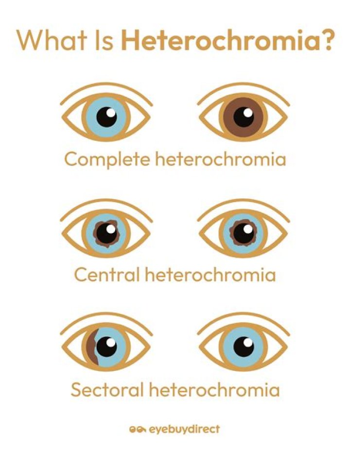 How do you get Heterochromia Iridis?